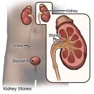 Kidney Stones Clinic 1 HOMOEOPATHIC TREATMENT FOR KIDNEY STONES