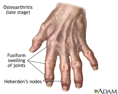 Homeopathic treatment in arthritis