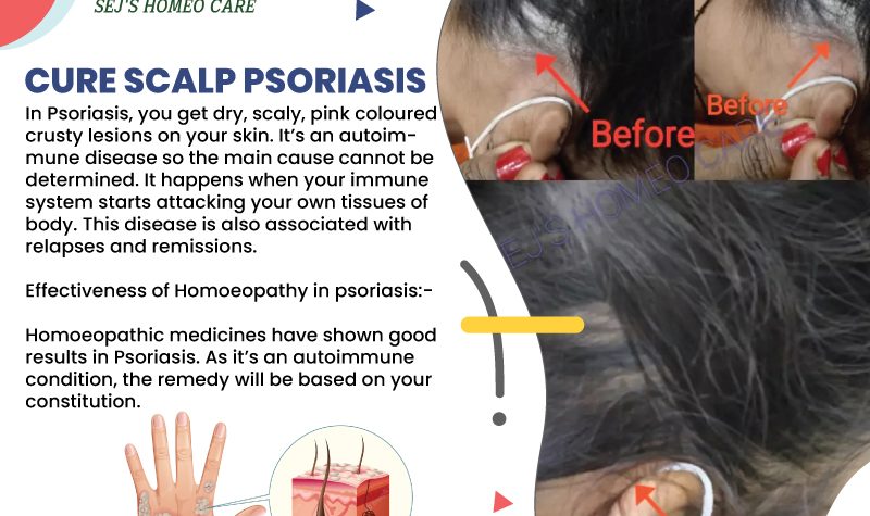 Cure Scalp Psoriasis Treatment